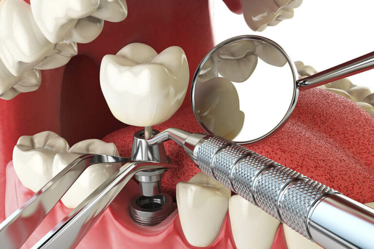 3D mockup of a dental implant being placed