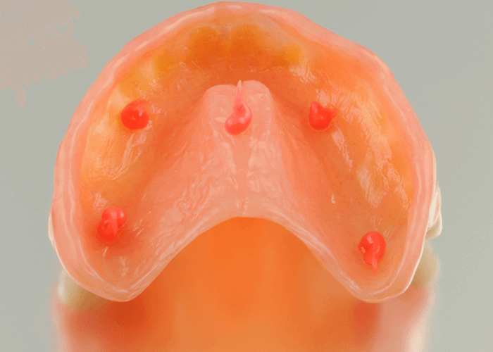 denture with five dots of denture adhesive on it